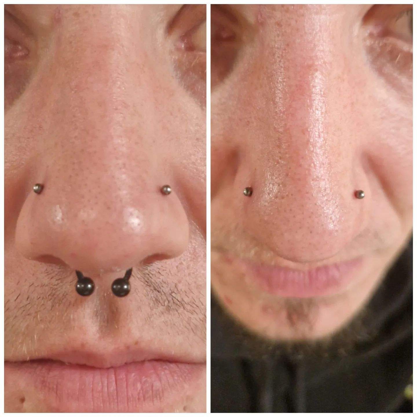 Bridge- und Septum-Piercing im direkten Vorher-Nachher-Vergleich